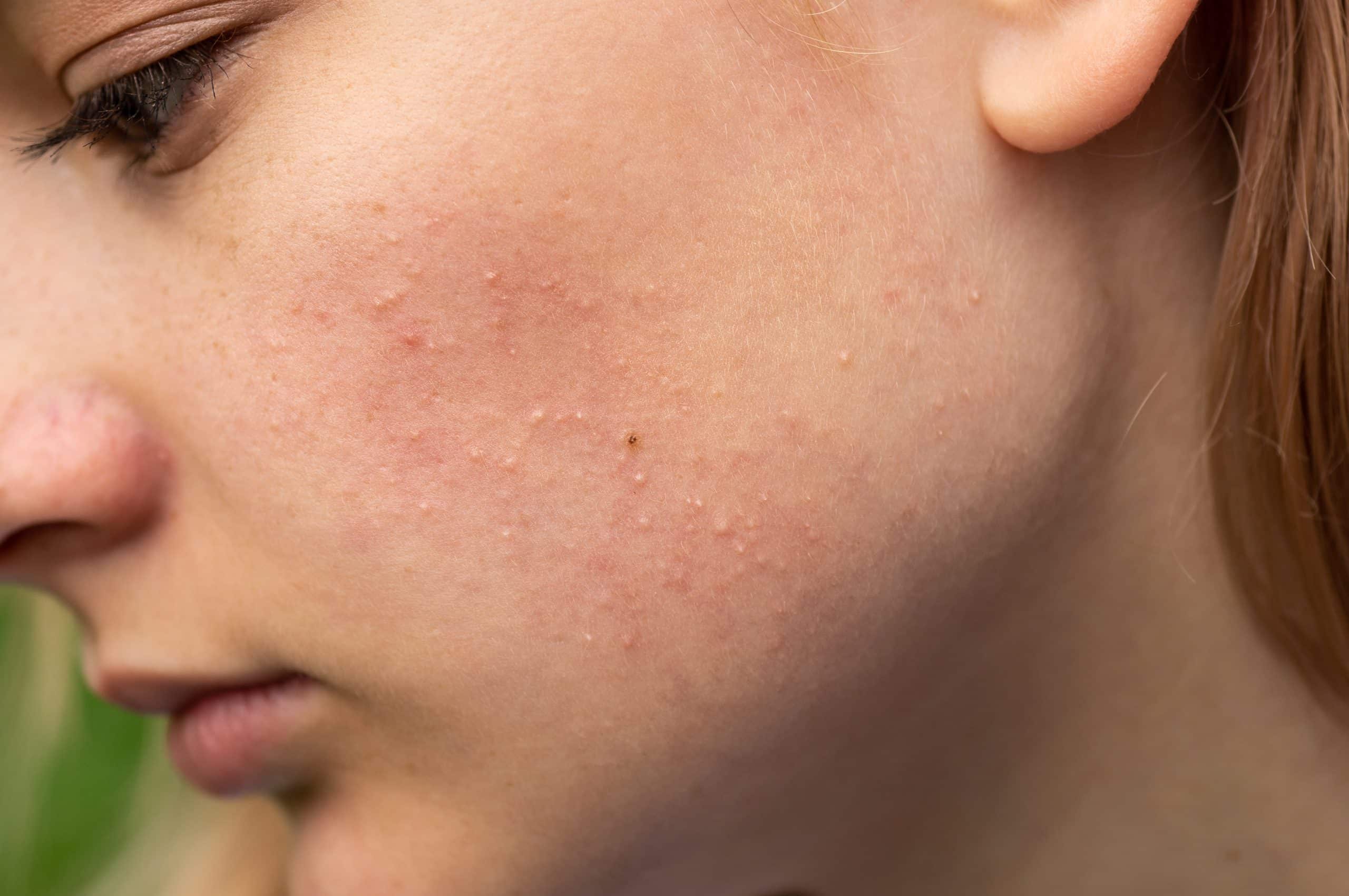 Problematic skin. Acne and red festering pimples on the face of a young girl. Facials for teen girls.