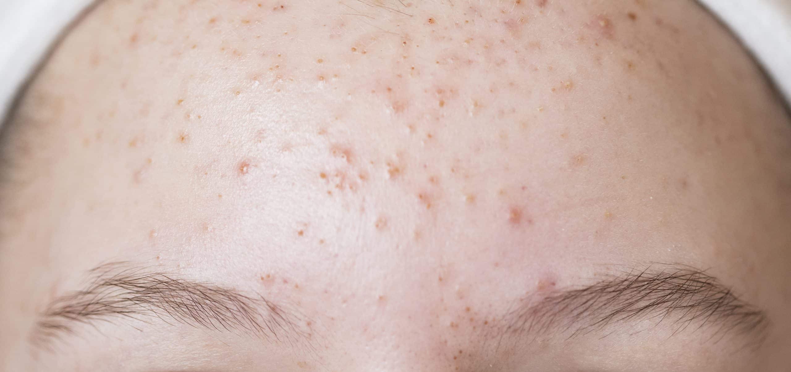 Problematic skin. Acne and red festering pimples on the face of