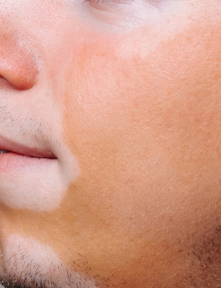 Young man male guy with vitiligo portrait in profile in studio in a business suit with a tie.